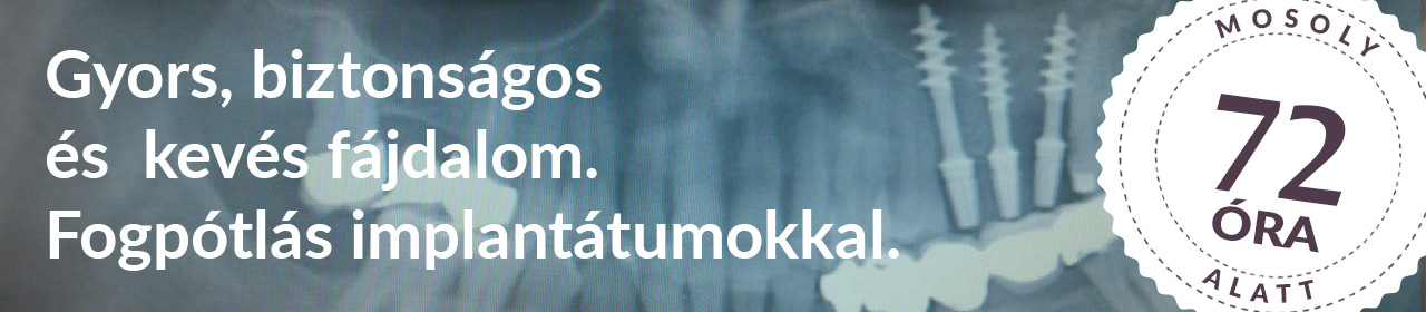 Gyors, biztonságos, fájdalommentes fogpótlás implantátumokkal
