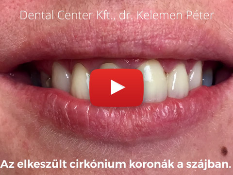 Fogpótlás esetbemutató