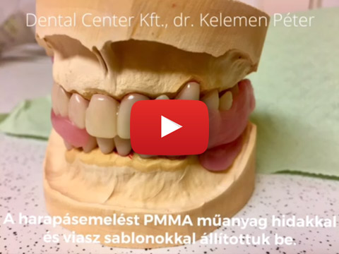 Fogpótlás esetbemutató